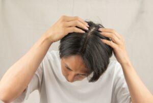 AGA治療初期脱毛はどれくらい抜ける？